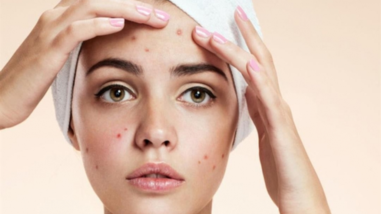 Top 10 Acne Myths Busted: What Really Causes Breakouts?